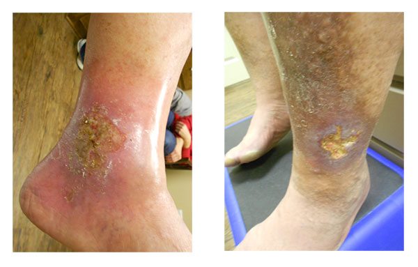A foot and leg with venous ulcers in Houston, TX