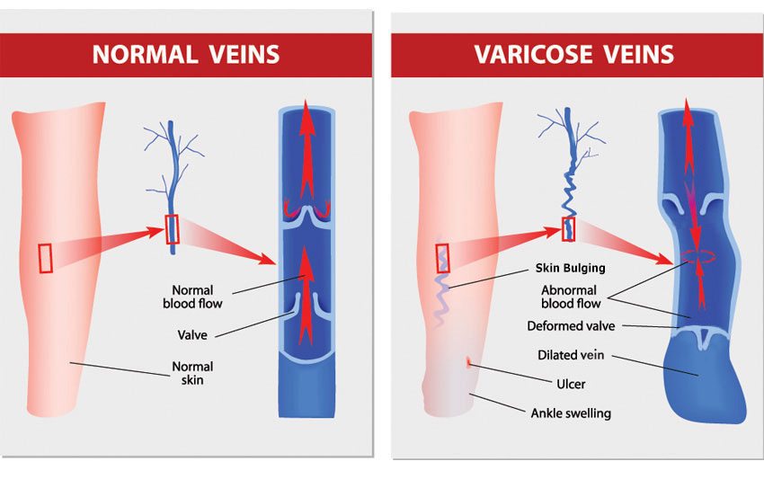 A diagram showing the difference between normal veins and those demonstrating venous insufficiency