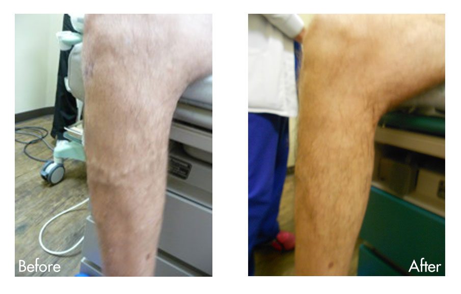Varicose Vein Before & After Photo