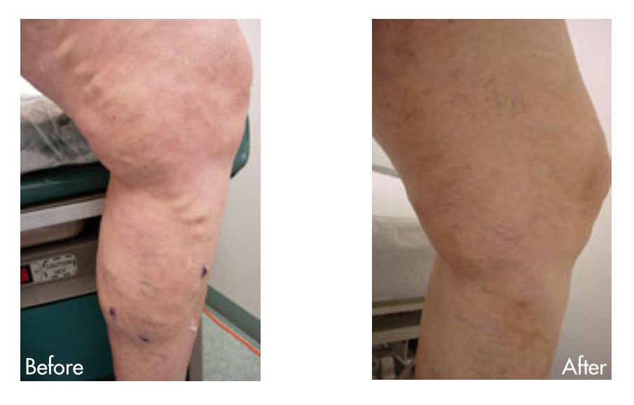 Varicose Vein Before & After Photo