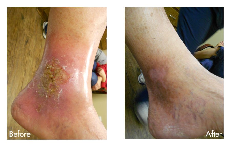 Venous Ulcers Before & After Photo