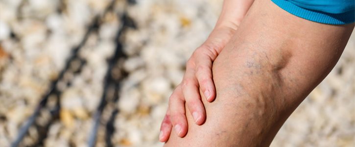 Spider Veins Don’t Have To Trouble You Anymore