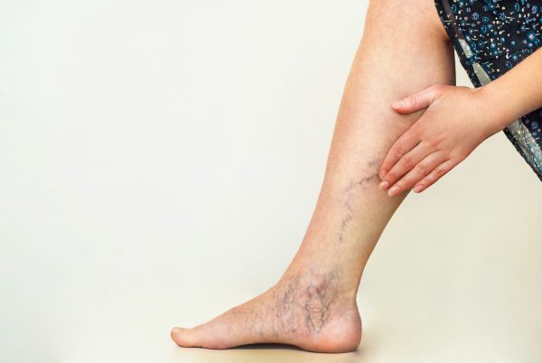 Should I be concerned about my Spider Veins?